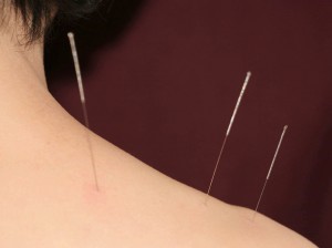 acupuncture